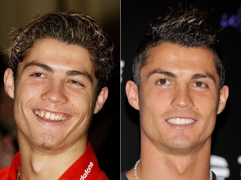 13 famosos antes e depois de ir ao dentista! Veja a diferença!