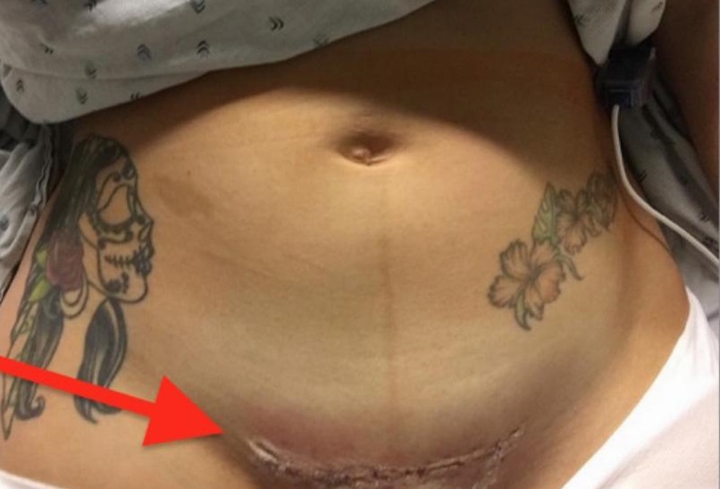 Essa jovem fez uma cirurgia para dar à luz sua filha. No dia seguinte, ela mostra uma foto do que aconteceu como seu corpo.