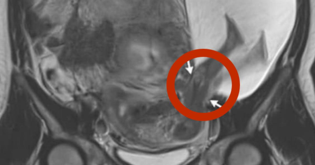 Esta mulher de 33 anos estava grávida do seu sexto filho. Quando os médicos olharam o ultrassom, eles notaram algo que nunca tinham visto antes.
