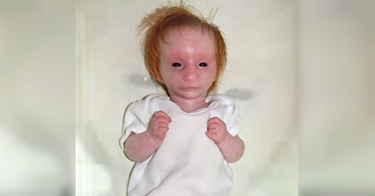 Bebê recém-nascido parece uma boneca de porcelana. 5 anos depois os médicos nem a reconhecem!